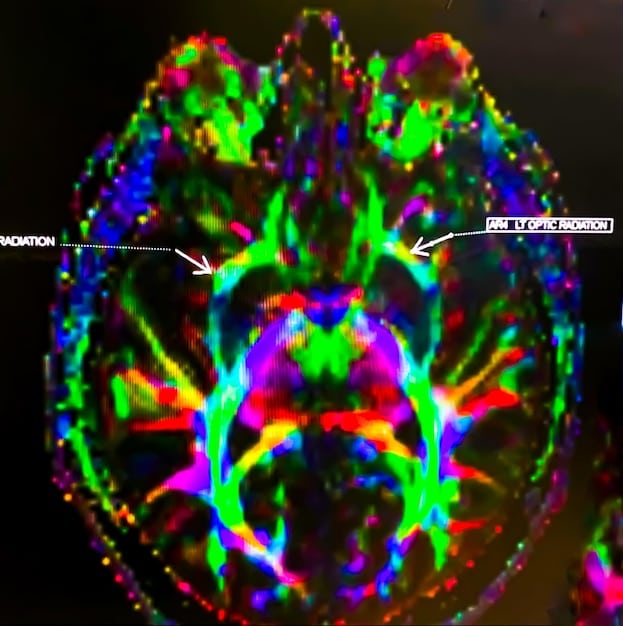 A close-up shot of brain scan images highlighting the areas of the brain activated during journaling, with annotations explaining the role of each area in emotional regulation and cognitive processing.